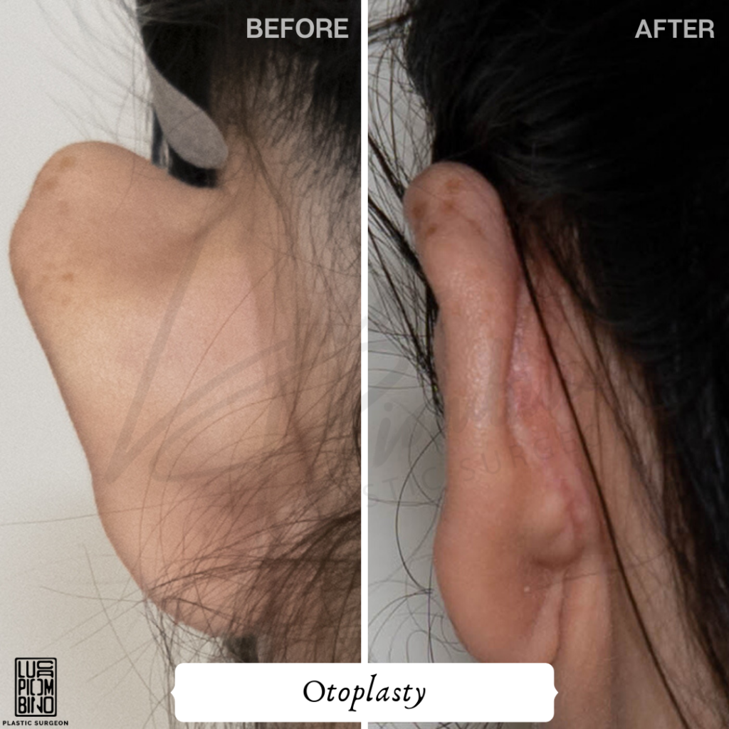 Cosmetic ear surgery: otoplasty procedures