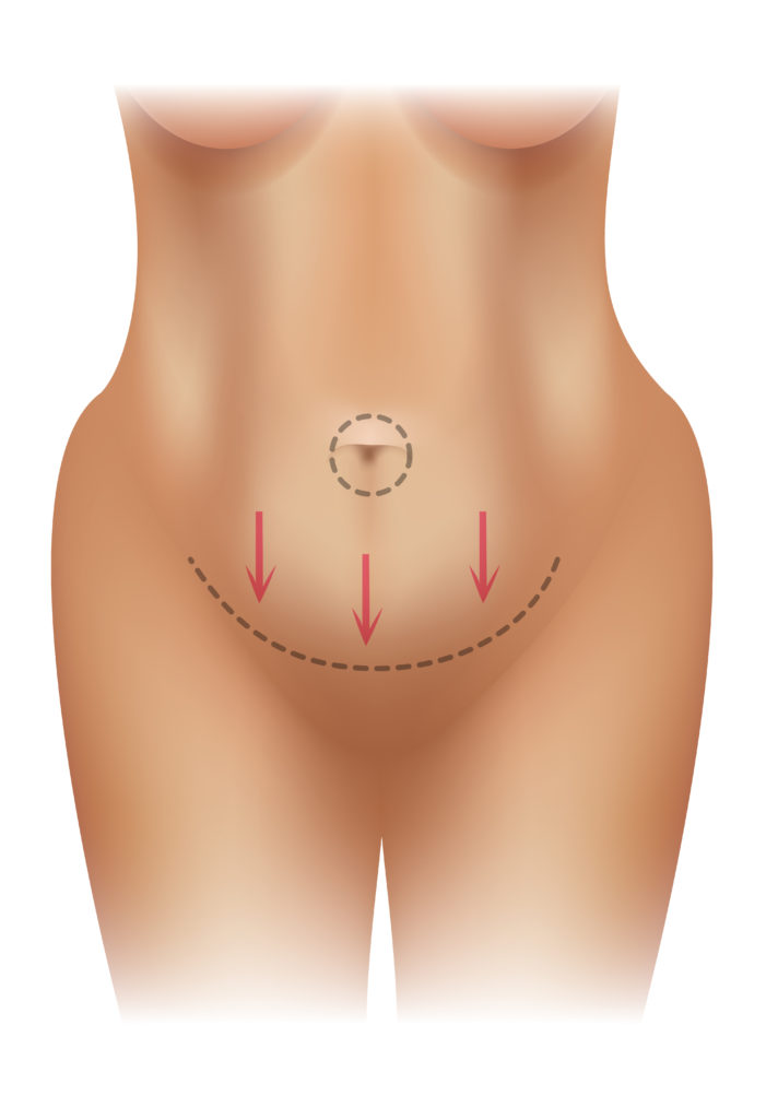 Muscle diastasis