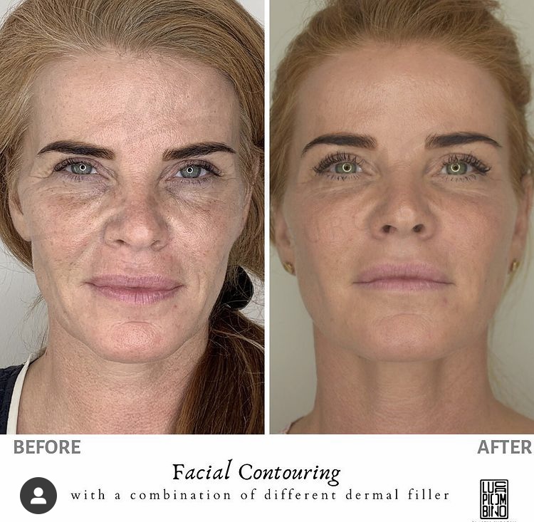Face Contouring: rejuvenating the face without a scalpel