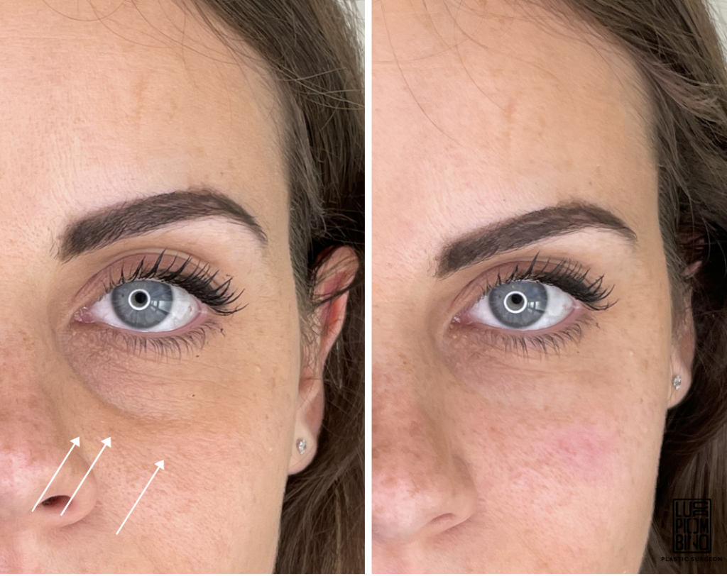 Filler Dark Circles