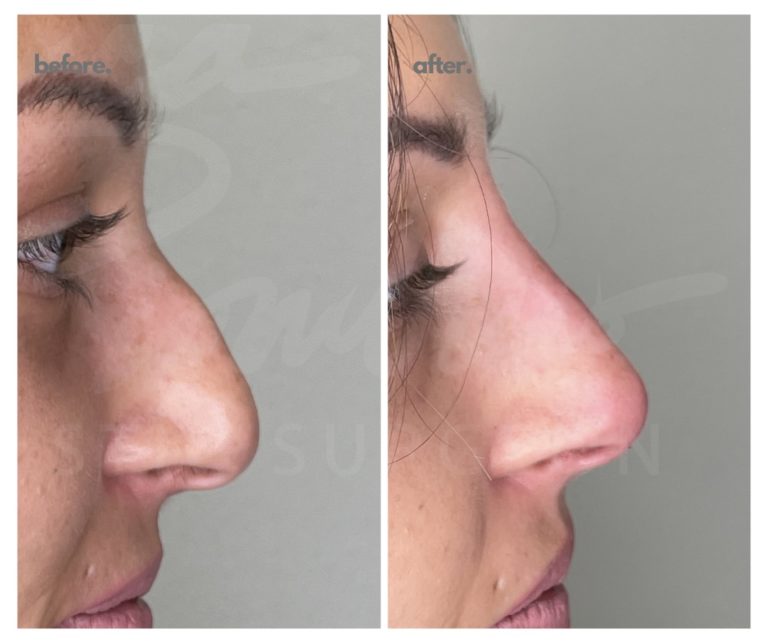 Reshape nose